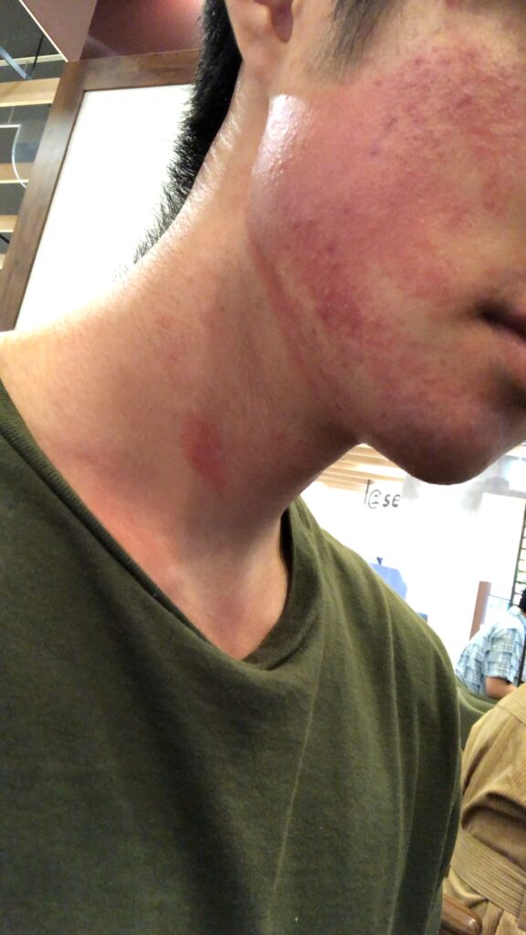 脱毛直後の肌状態