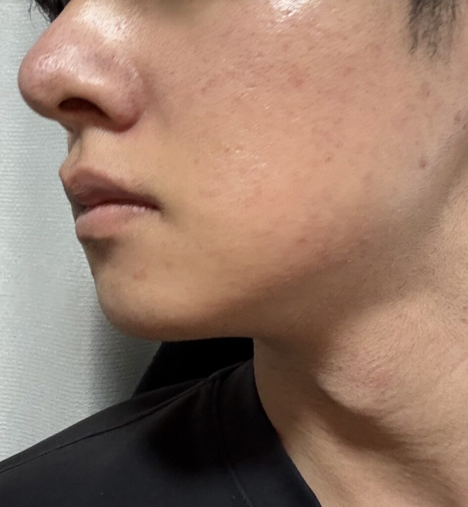 施術後2週間が経った肌状態